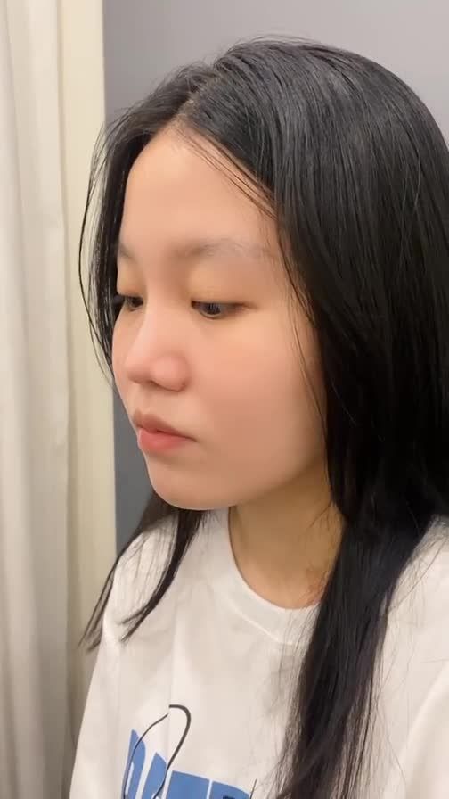 MŨI TẸT GẦN NHƯ KHÔNG CÓ SỐNG MŨI VÀ KẾT QUẢ SAU 4 THÁNG ĐƯỢC SỞ HỮU DÁNG MŨI TỰ NHIÊN PHONG THỦY TẠI BÁC SĨ KHẢI
