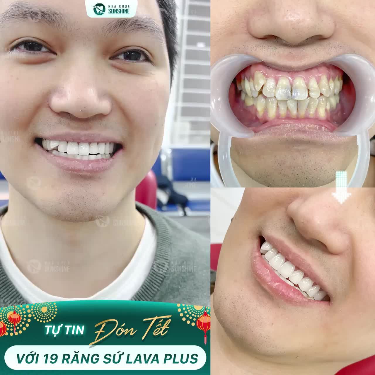 TỰ TIN ĐÓN TẾT – RĂNG HẾT XỈN MÀU - GIẢI QUYẾT TRIỆT ĐỂ RĂNG NHIỄM TETRACYCLINE.