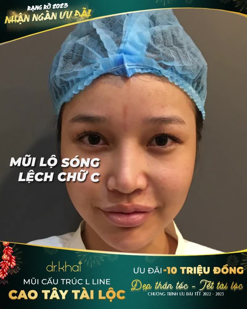 NGÀY TẾT MUỐN XINH - DÁNG MŨI PHẢI ĐỈNH  TẠO HÌNH MŨI PHONG THUỶ GIẢM NGAY 10TR