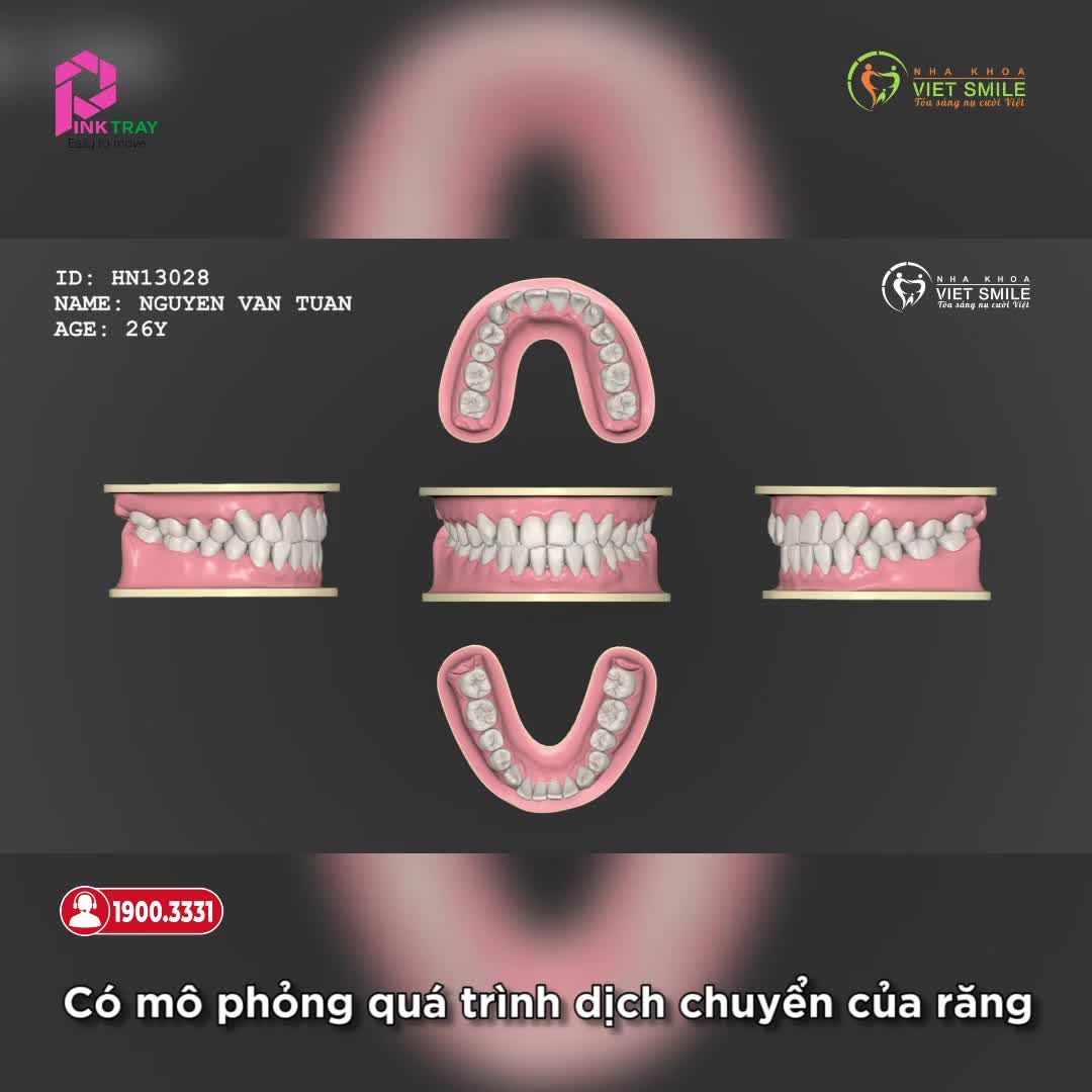 NIỀNG RĂNG TRONG SUỐT PINKTRAY - THẨM MỸ CAO, DỄ DÀNG THÁO LẮP