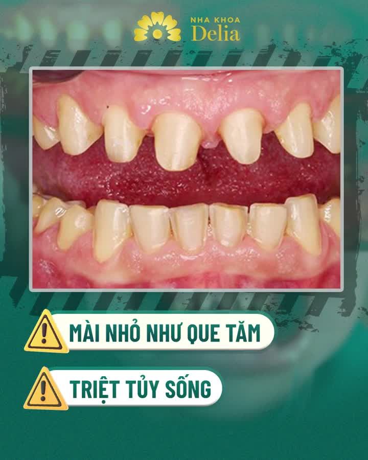 CAM KẾT BẢO TỒN RĂNG GỐC