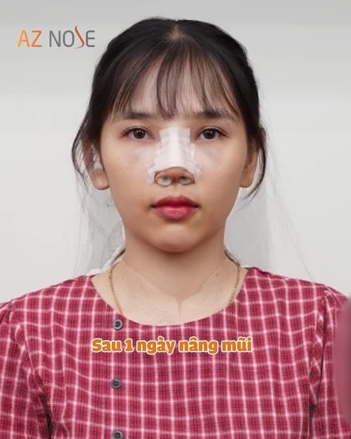 Cô nàng 2K1 khoe mũi "xịn" trước thềm Giáng Sinh