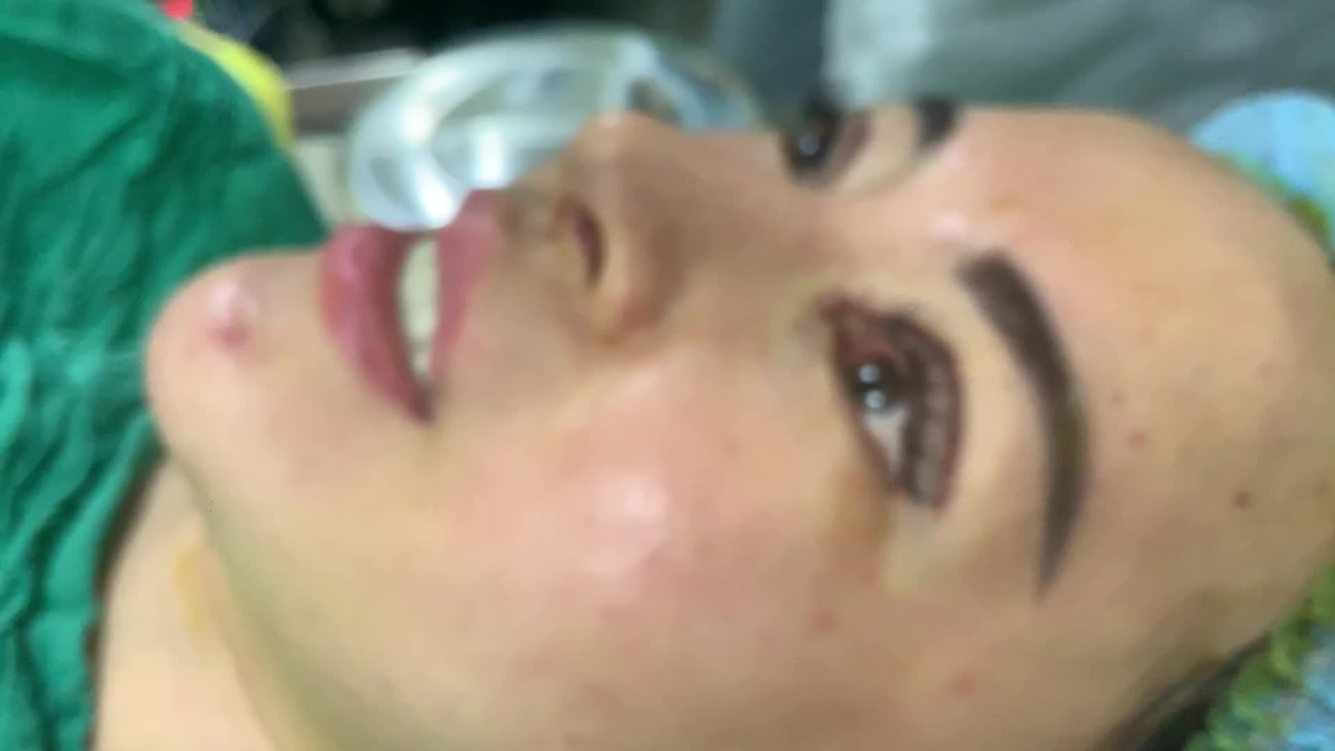 Combo sửa mí trên, hạ size mí, ghép mỡ  mở góc trong cho bạn gái từ quận Tân Bình, TpHCM