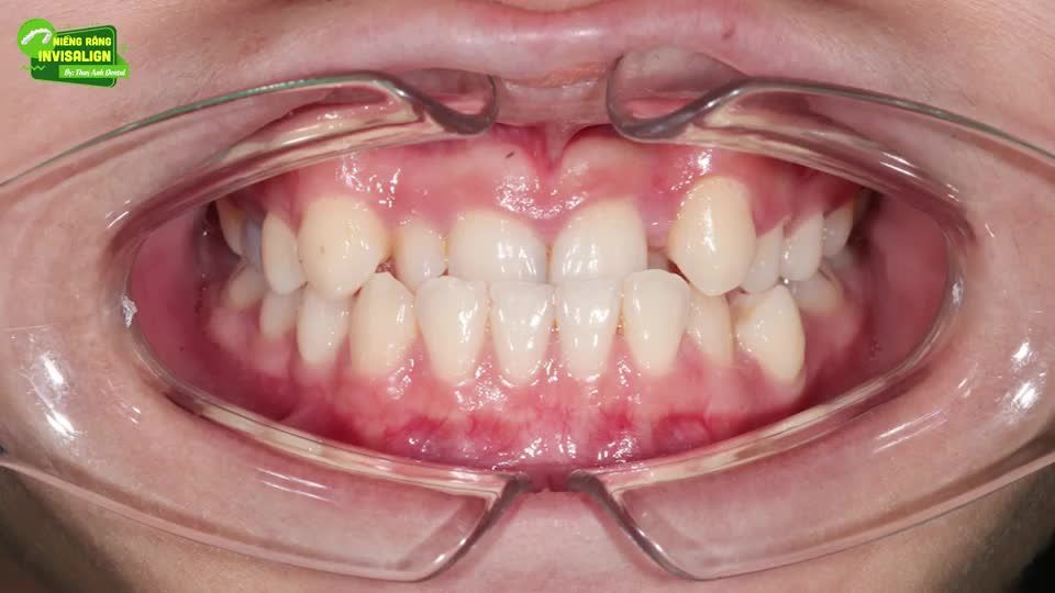 CHỌN INVISALIGN - CHỌN THẨM MỸ TỐI ĐA, TIỆN LỢI TỐI ƯU