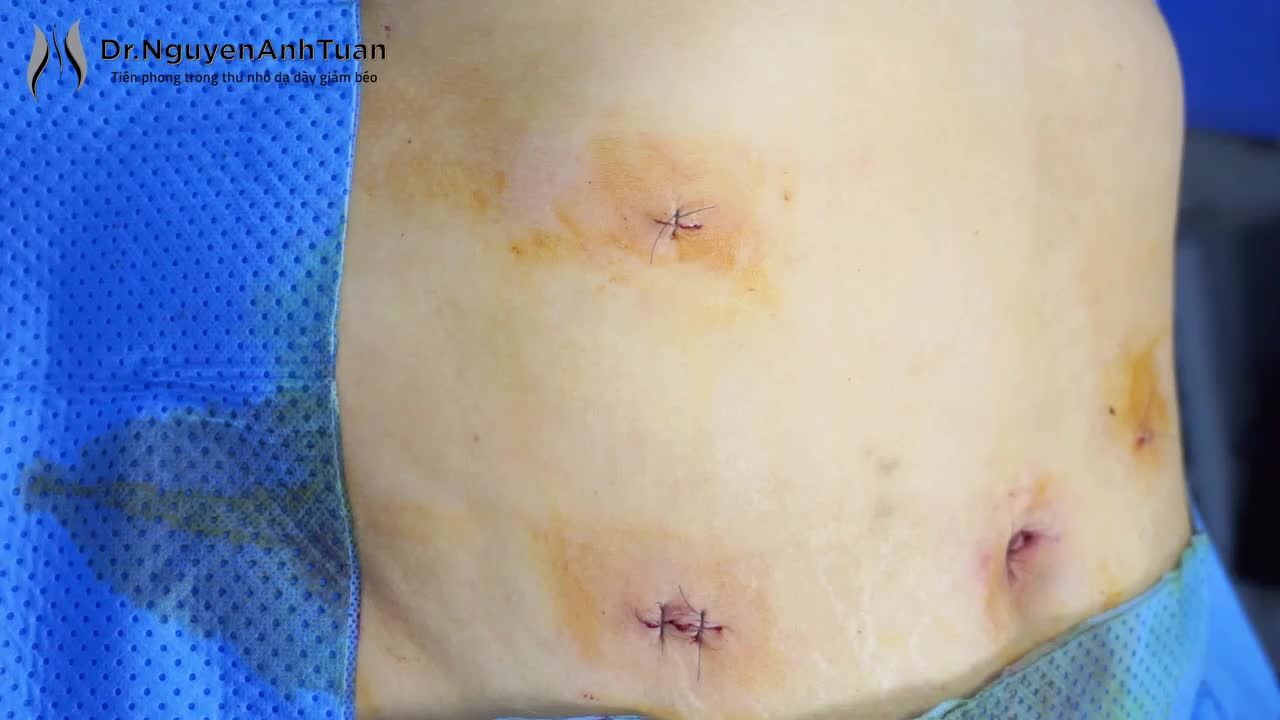 Nhiều bệnh nhân khi lựa chọn phương pháp thu nhỏ dạ dày để giảm béo thường băn khoăn rằng liệu vết mổ có to không và có đau không?