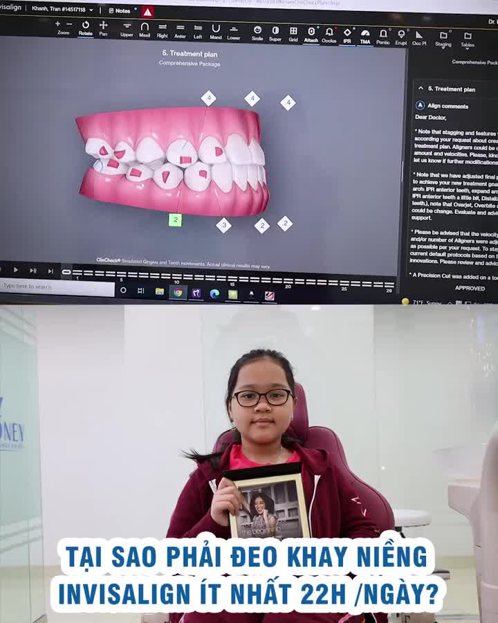 Tại sao phải đeo khay niềng Invisalign ít nhất 22h/ngày?