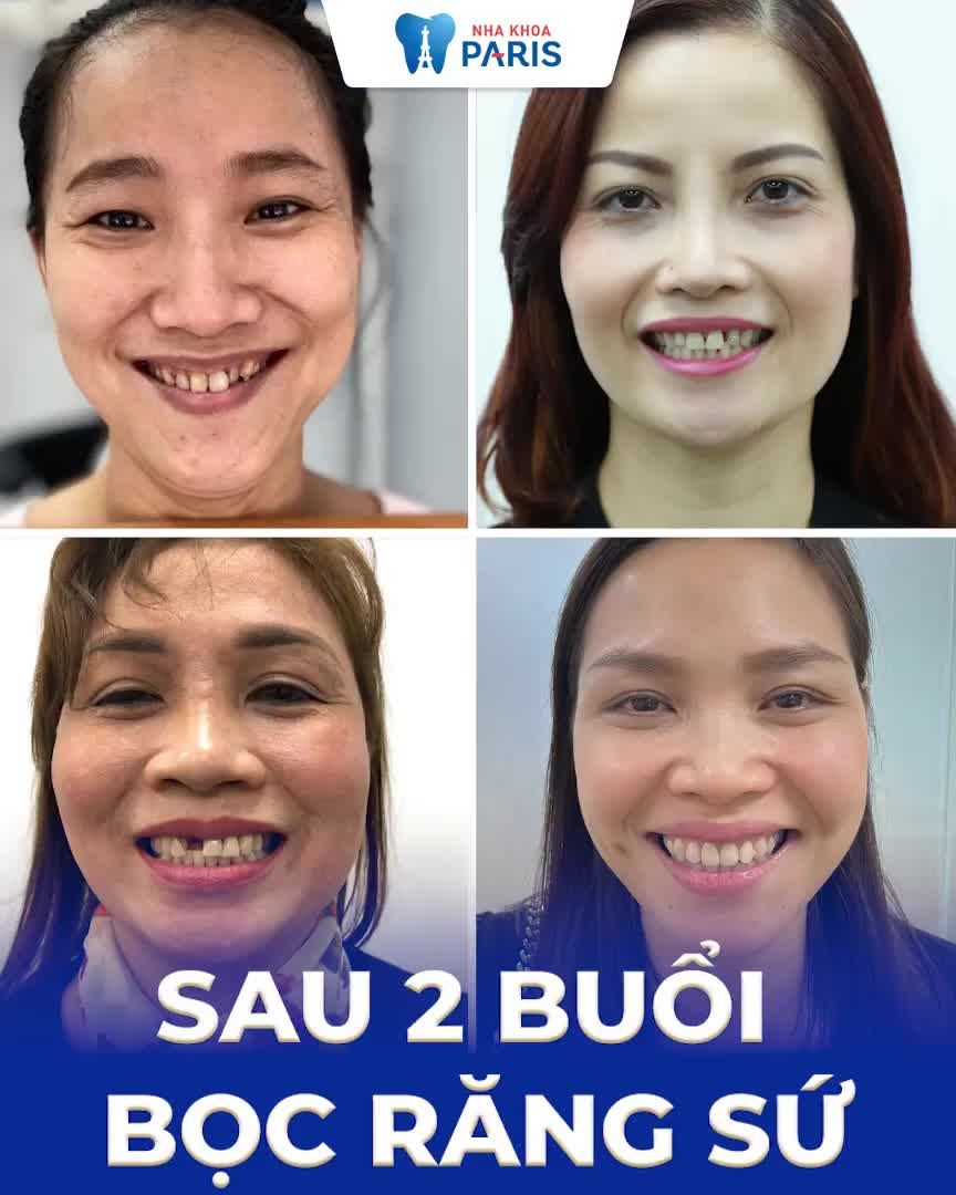 Răng nhiễm tetracycline Xỉn màu thuốc lá