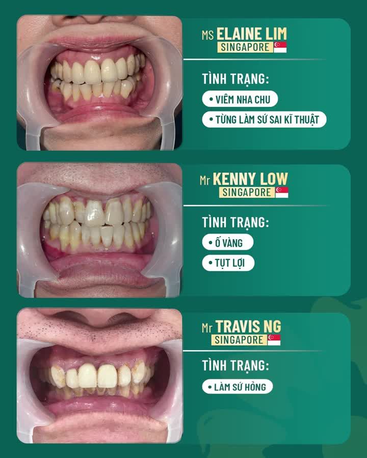 Thẩm mỹ 20 răng sứ Lava Plus - Khách hàng Singapore hài lòng tuyệt đối