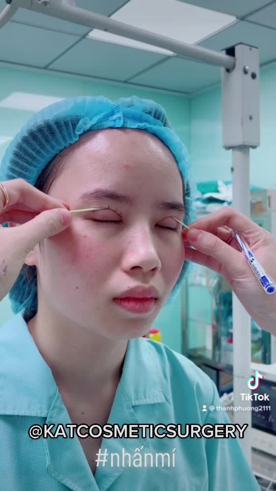 Chỉ với 30 phút phẫu thuật KAT đã giúp bạn tạm biệt đôi mắt không đều, sụp mí  và trao lại một đôi mắt hai mí long lanh biết nói.