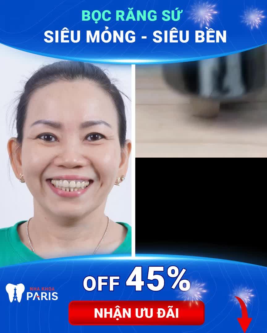 Làm Răng Rước Lộc - Giá Tốt Nhất Năm