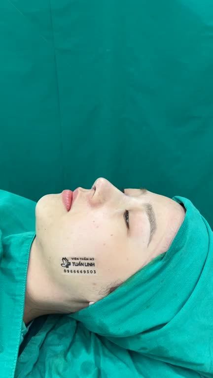 Nâng mũi tặng độn cằm khuyến mãi siêu khủng chưa từng có tại tuấn Linh