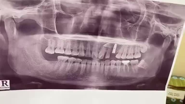 Trồng răng nhân tạo Implant cho anh khách hàng tại Nha Khoa Thùy Anh cơ sở tp. Thái Nguyên