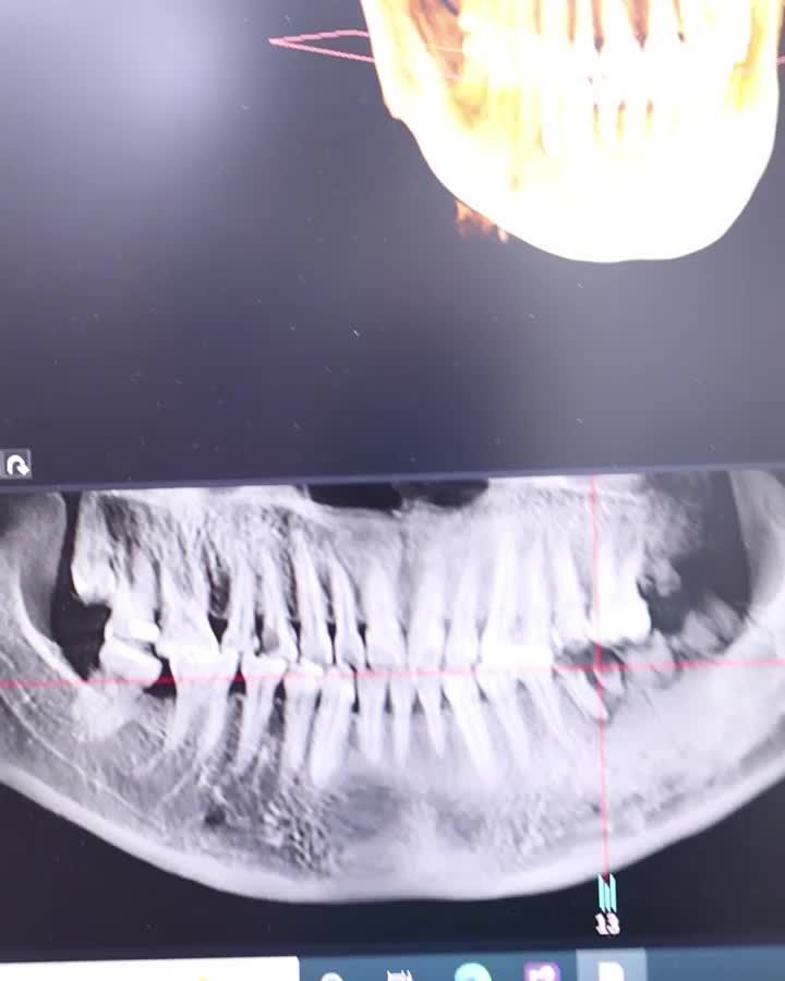 Cấy bao nhiêu trụ Implant cho 1 hàm thì chắc chắn?