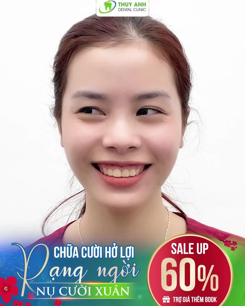 CHỮA CƯỜI HỞ LỢI ĐẸP NHANH TẾT CƯỜI THẢ PHANH