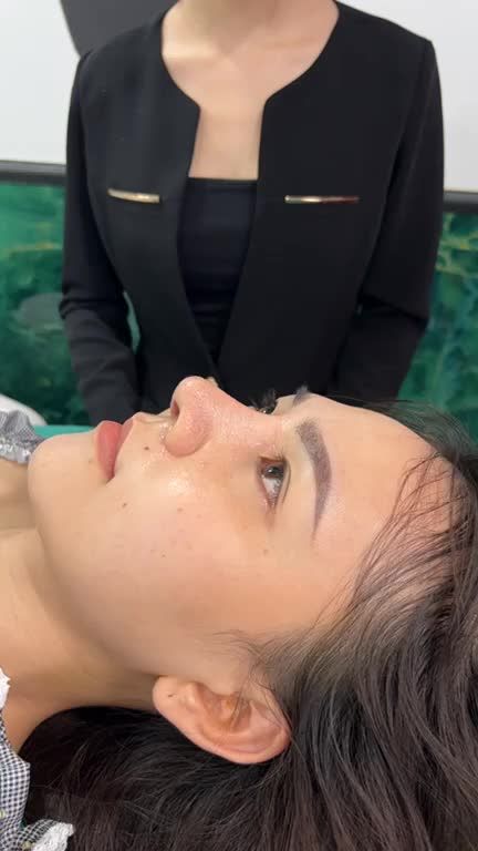 Kết quả nâng mũi cấu trúc sau 10 ngày tái khám