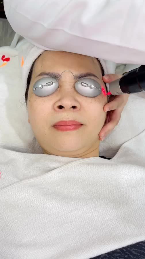 Chị khách hàng Việt Kiều trở về Việt Nam để điều trị tàn nhang với Laser Picosure tại Kangnam.