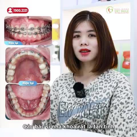 NIỀNG RĂNG GIẢM CHEN CHÚC VỚI LỘ TRÌNH, CHI PHÍ PHÙ HỢP