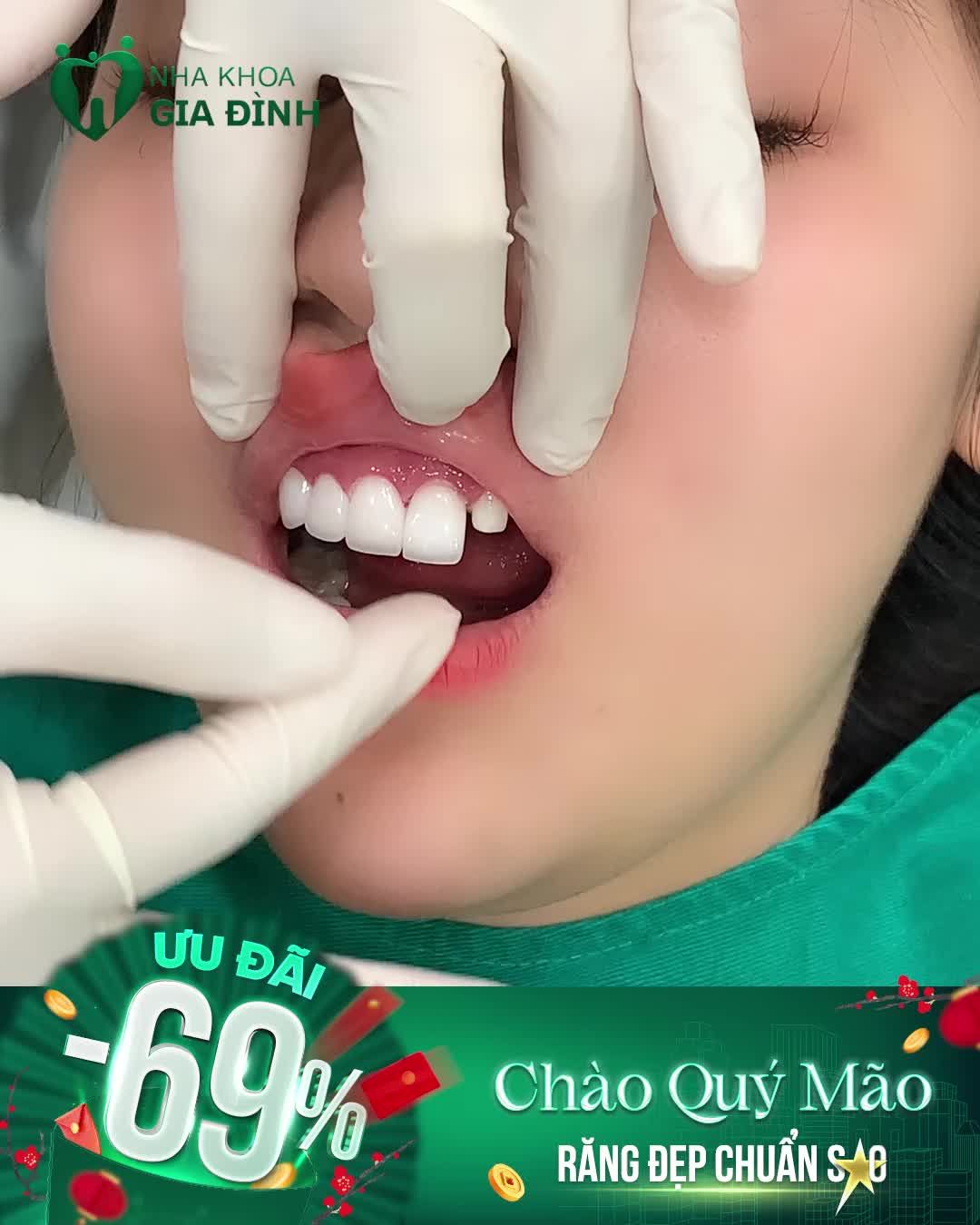 RĂNG TRẮNG CỰC XINH - TẾT VUI HẾT MÌNH