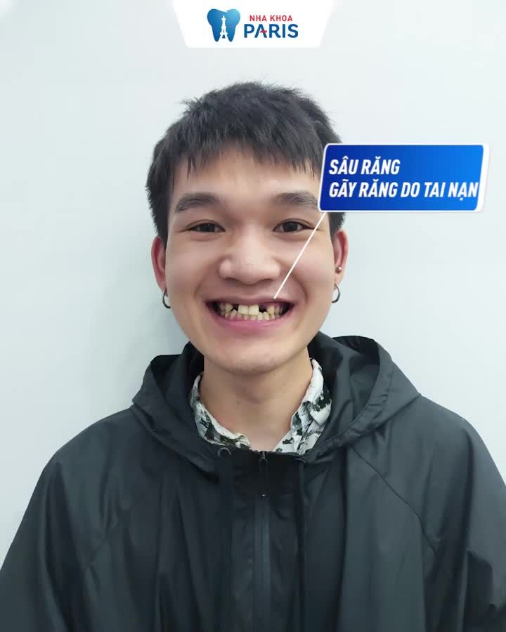 CHỈ 2 NGÀY KHÔI PHỤC RĂNG MẤT