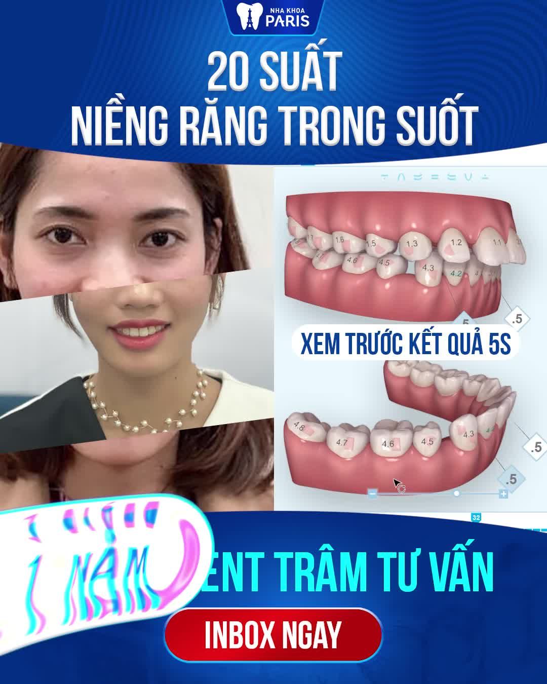ĐEO NIỀNG VÔ HÌNH - TỰ TIN ĂN TẾT