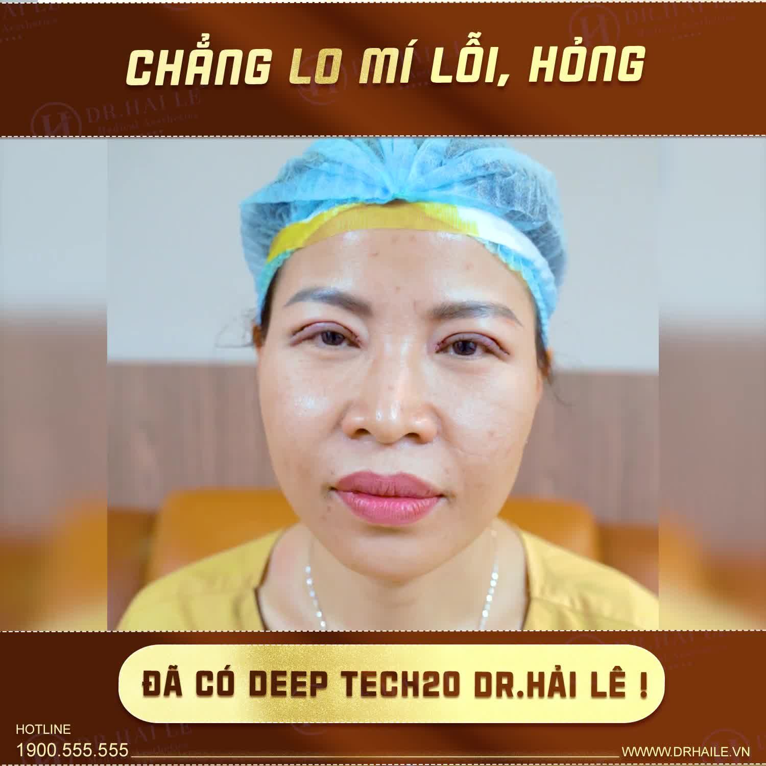 Vị khách hàng đã thực hiện cắt mí tại một cơ sở thẩm mỹ kém uy tín, khiến cho đôi mắt không tự nhiên và không được như chị mong muốn