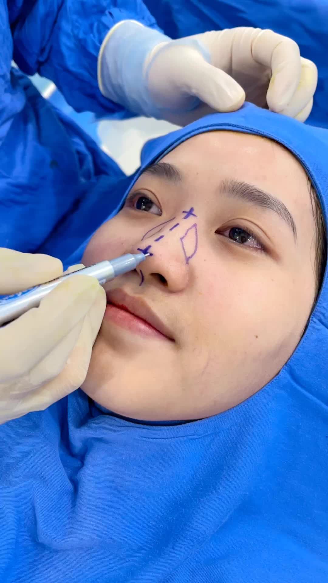 Phân tích Nâng mũi 6D Sugiform cùng cô nàng Biên tập viên tại Hà Nội