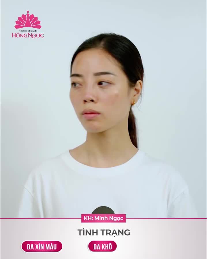 THỰC HIỆN MESO PERFECT FACE TẠI HỒNG NGỌC CÓ GÌ ĐẶC BIỆT