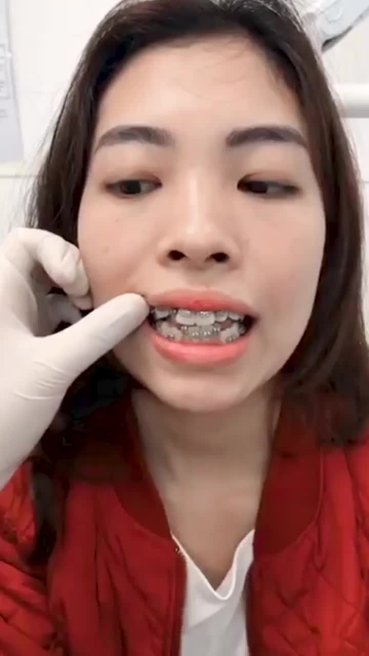 Niềng răng chữa hô Khấp khểnh thế nào?
