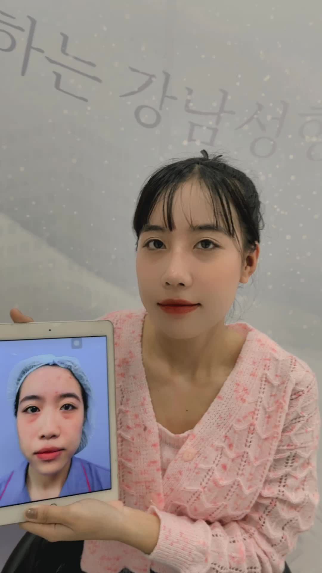 Cô nàng Nâng mũi 6D sau 10 ngày quay lại xinh xắn rạng rỡ!