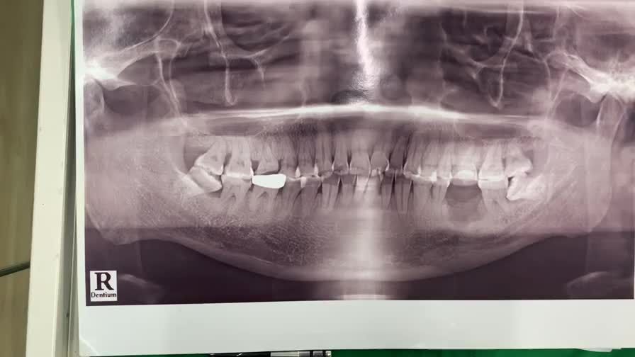 Lắp răng implant khôi phục lại răng 36 bị mất cho chú khách hàng tại Nha Khoa Thuỳ Anh.