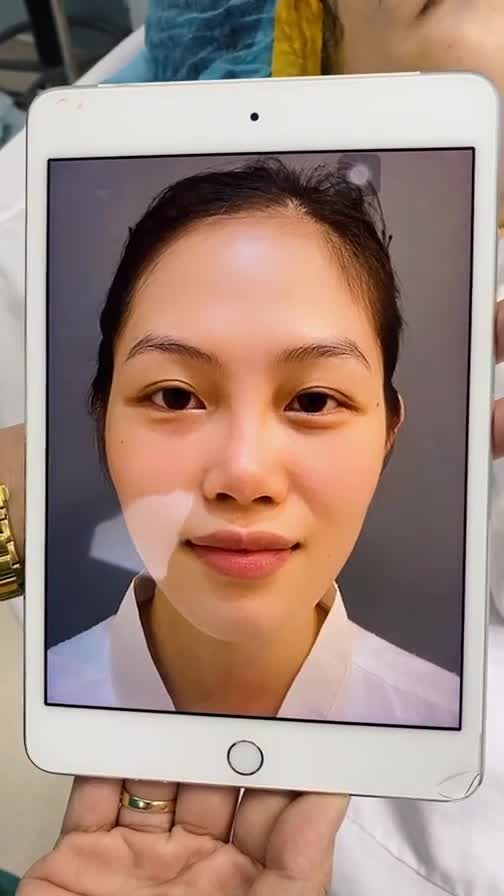 TẠI PHÒNG PHẪU THUẬT BÁC SĨ KHẢI  TÁI TẠO CẤU TRÚC MŨI SAU KHI XỬ LÝ FILLER