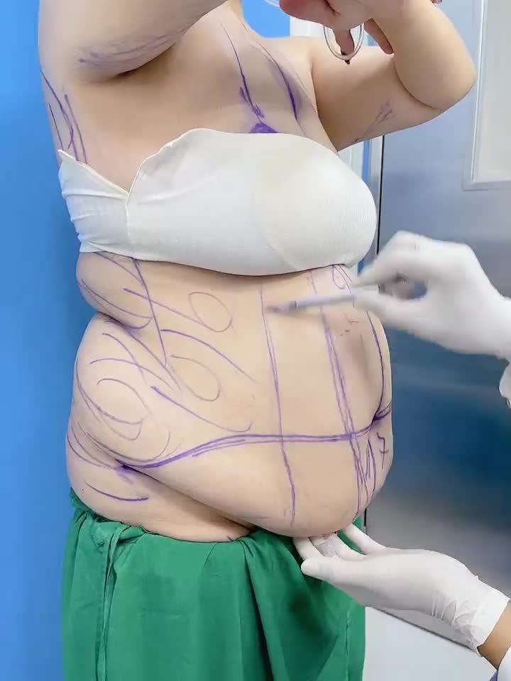 GIẢI CỨU Bụng mỡ siêu to khổng lồ - Quy trình đo vẽ trước phẫu và thăm khám trước phẫu