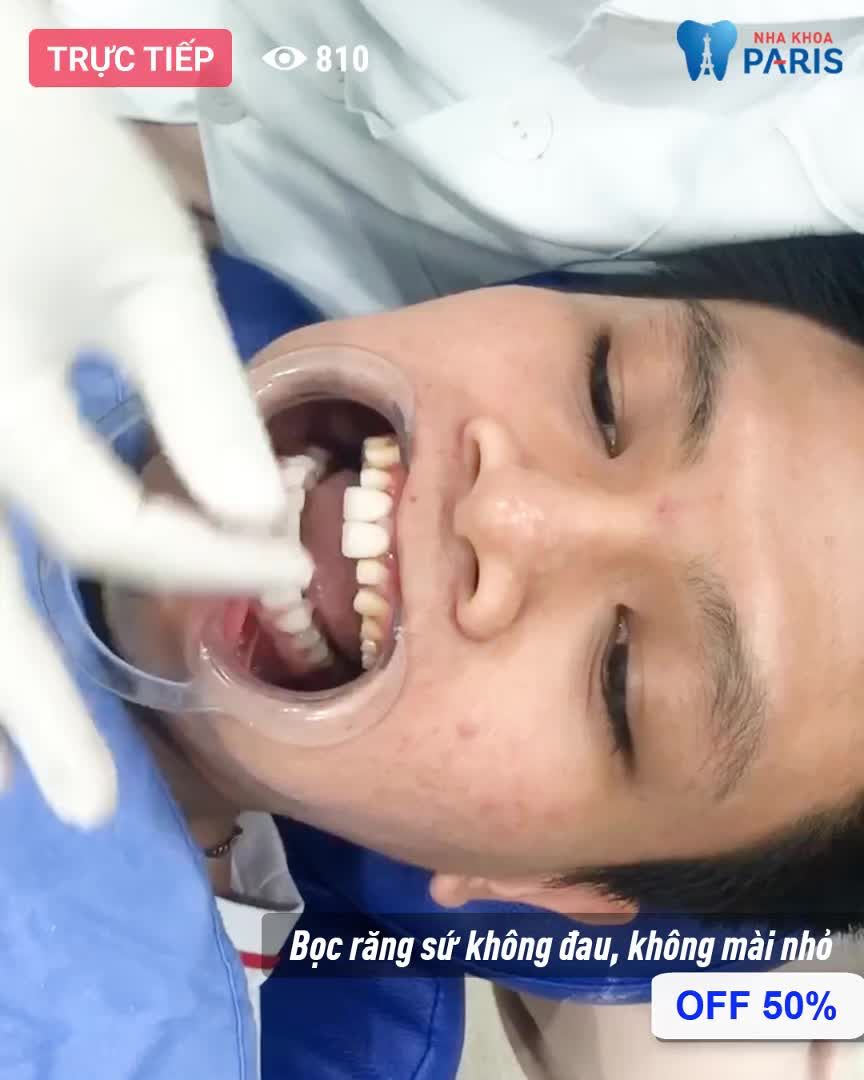 Cận Cảnh Quá Trình Bọc Răng Sứ
