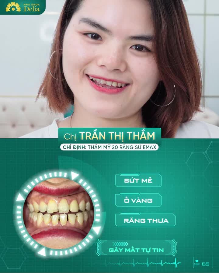 SAU 2 LẦN HẸN RĂNG TRẮNG SÁNG - ĐỀU ĐẸP - TỰ TIN GIAO TIẾP