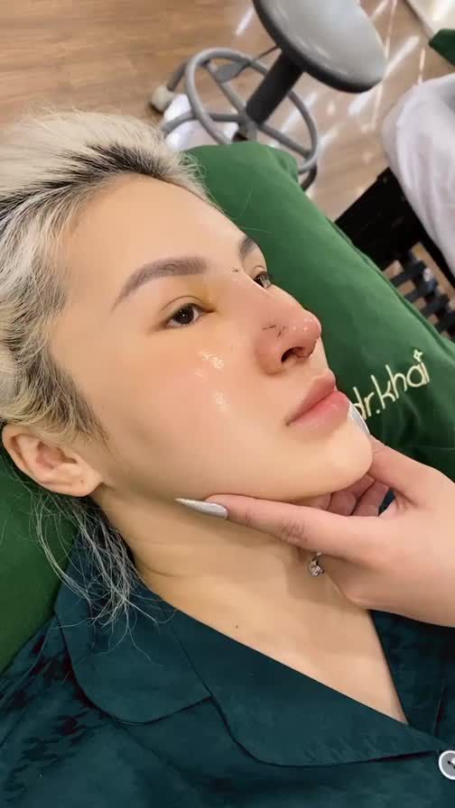 KẾT QUẢ NÂNG MŨI ĐẸP 5 NGÀY VỚI DÁNG MŨI PHONG THỦY VỚI CHẤT LIỆU SỤN SƯỜN TOÀN PHẦN