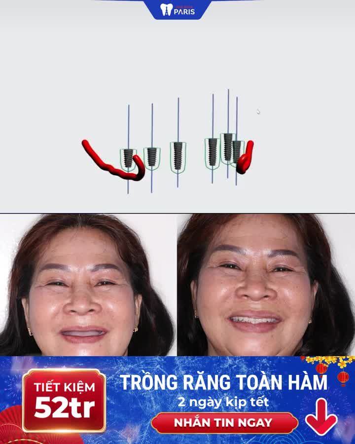 20 SUẤT TRỒNG RĂNG ALL ON GIẢM 20%