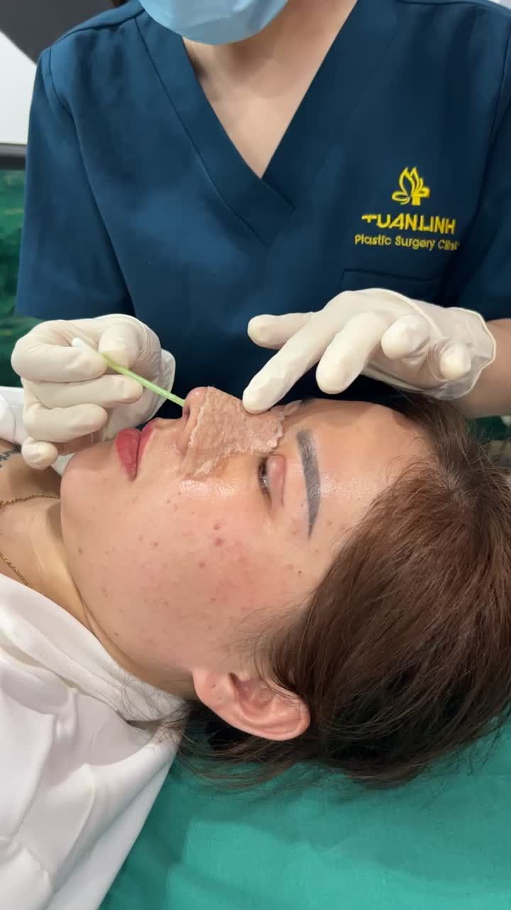 Case mũi cấu trúc + mí được 5 ngày