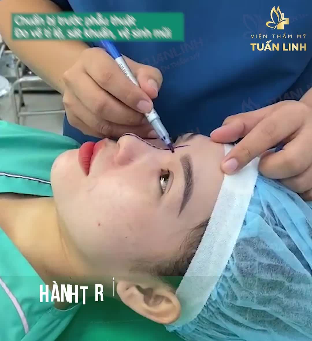 90 phút nhẹ nhàng của cô bạn xinh xắn chọn nâng mũi cấu trúc sụn surgiform