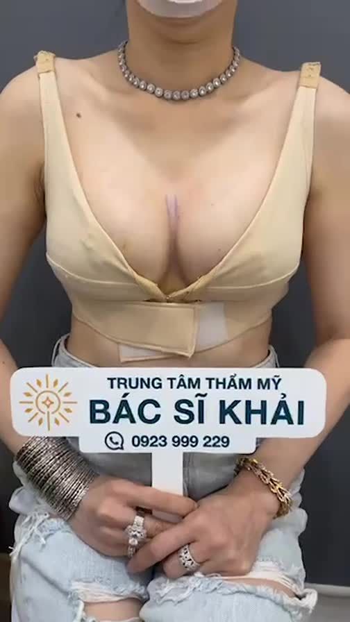 KẾT QUẢ NÂNG VÒNG 1 CỰC XINH, CĂNG TRÒN CHỈ SAU 9 NGÀY