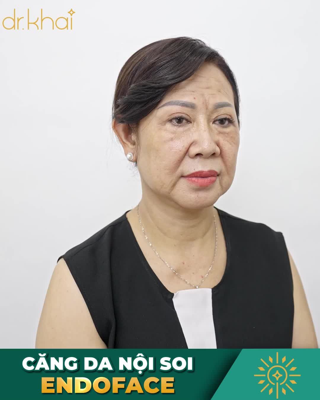 TỰ TIN KHOE DA NHỜ CĂNG DA NỘI SOI ENDOFACE