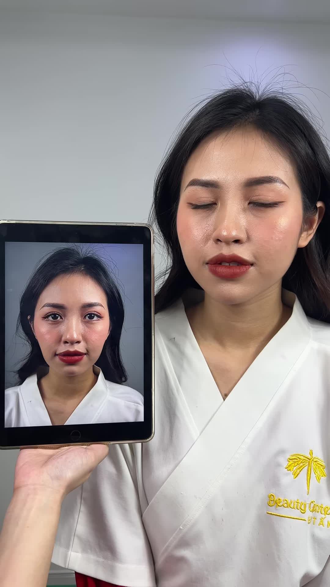 Ca Filler má, cằm tại phòng khám thẩm mỹ viện Tấm. Mọi người cùng theo dõi để thấy sự thay đổi trước và sau làm của bạn khách hàng nhé