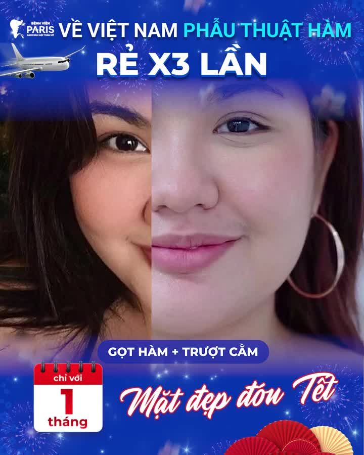 Giảm tới 40% Gọt hàm + Phẫu thuật hàm hô móm