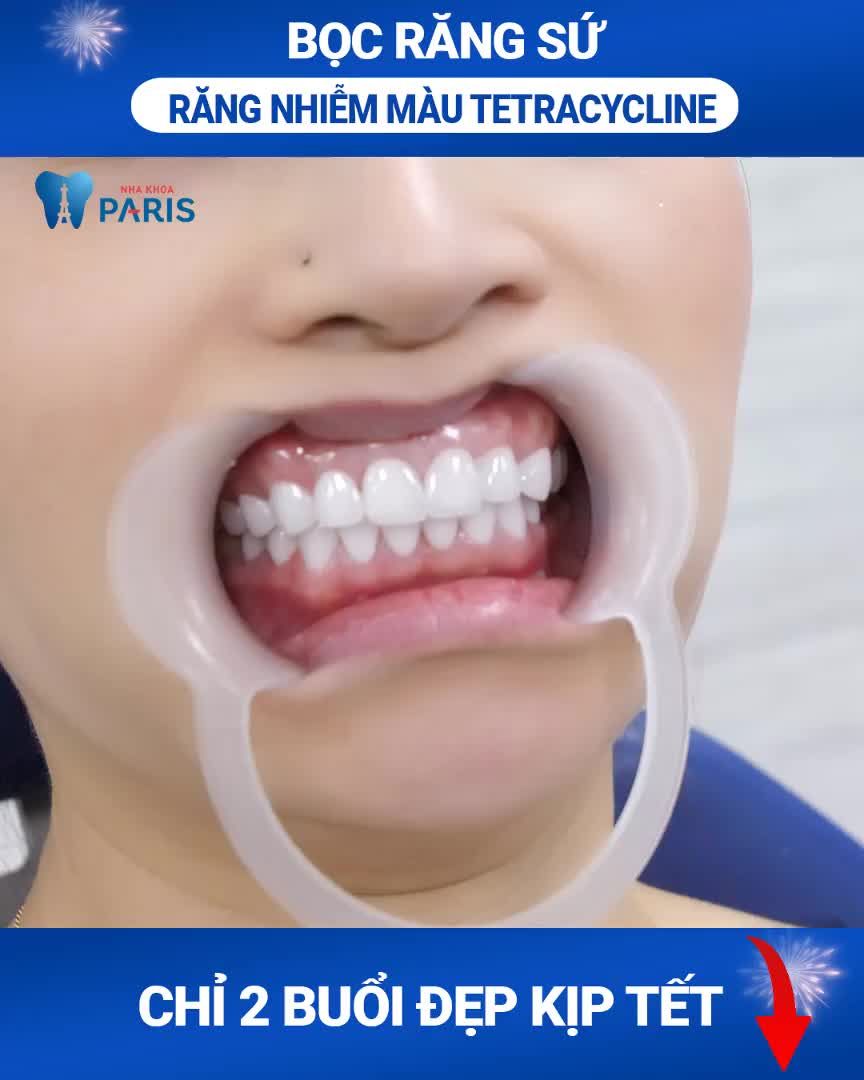60 Phút Bọc răng sứ đón Tết Như Ý