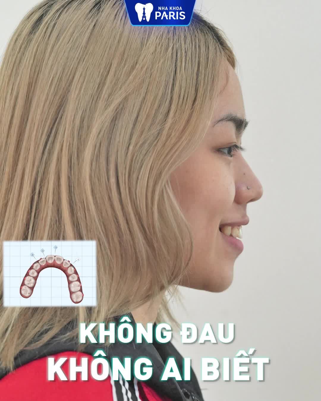 5 SUẤT CUỐI NIỀNG RĂNG INVI