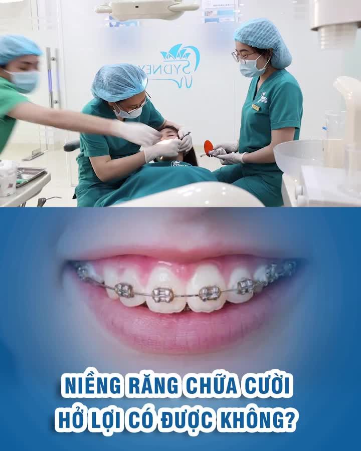 Niềng răng chữa cười hở lợi có được không?