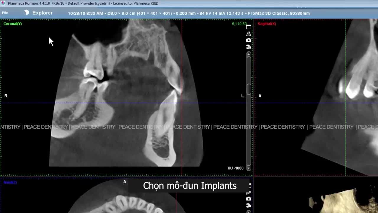 ĐẶT IMPLANT MÔ PHỎNG TRÊN PHẦN MỀM