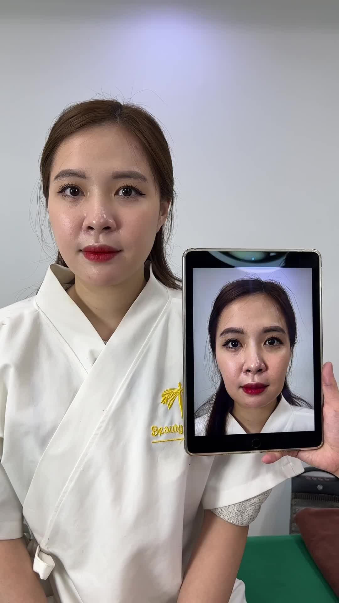 Bạn khách vừa trải nghiệm xong dịch vụ filler má, cằm. Mọi người cùng theo dõi để thấy sự thay đổi rõ rệt của bạn khách sau 30p nhé.