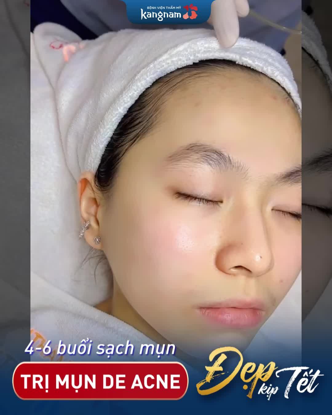 OFF 50% Sạch mụn đón Tết chỉ từ 190k