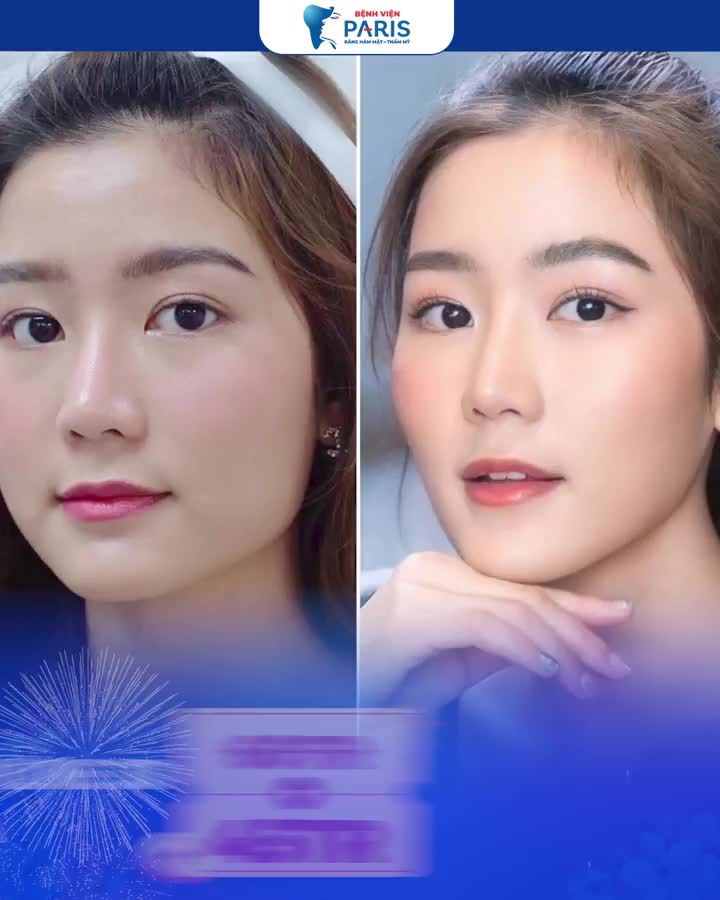 Thời điểm vàng Gọt hàm, Trượt cằm đẹp kịp đón tết