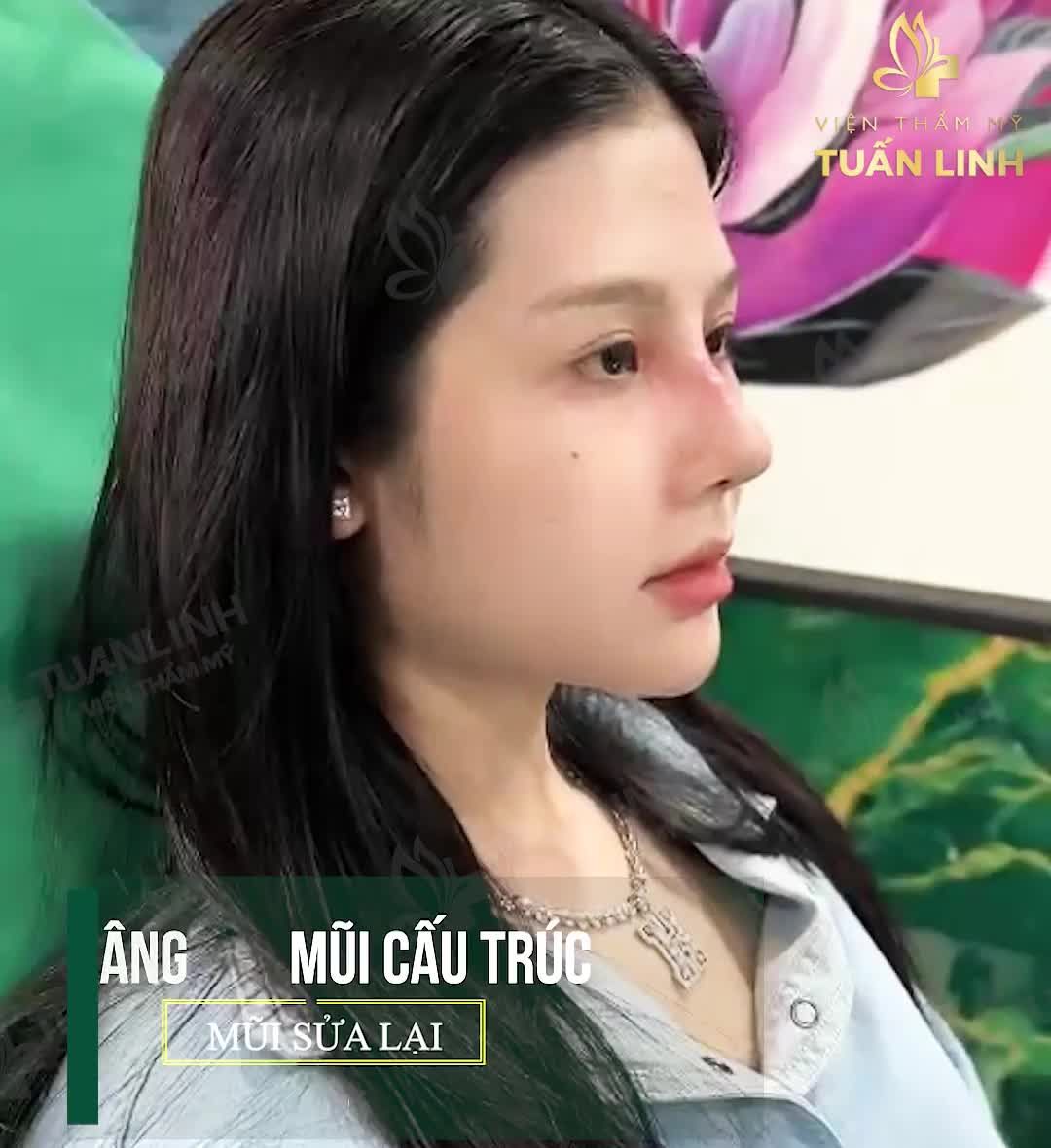 Dáng mũi cao thon giúp gương mặt thanh tú hơn, các đường nét hài hòa tự nhiên, cân đối.